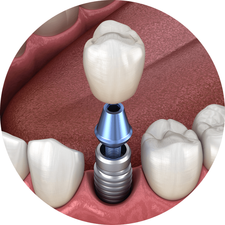 dental-implants-model-2-1